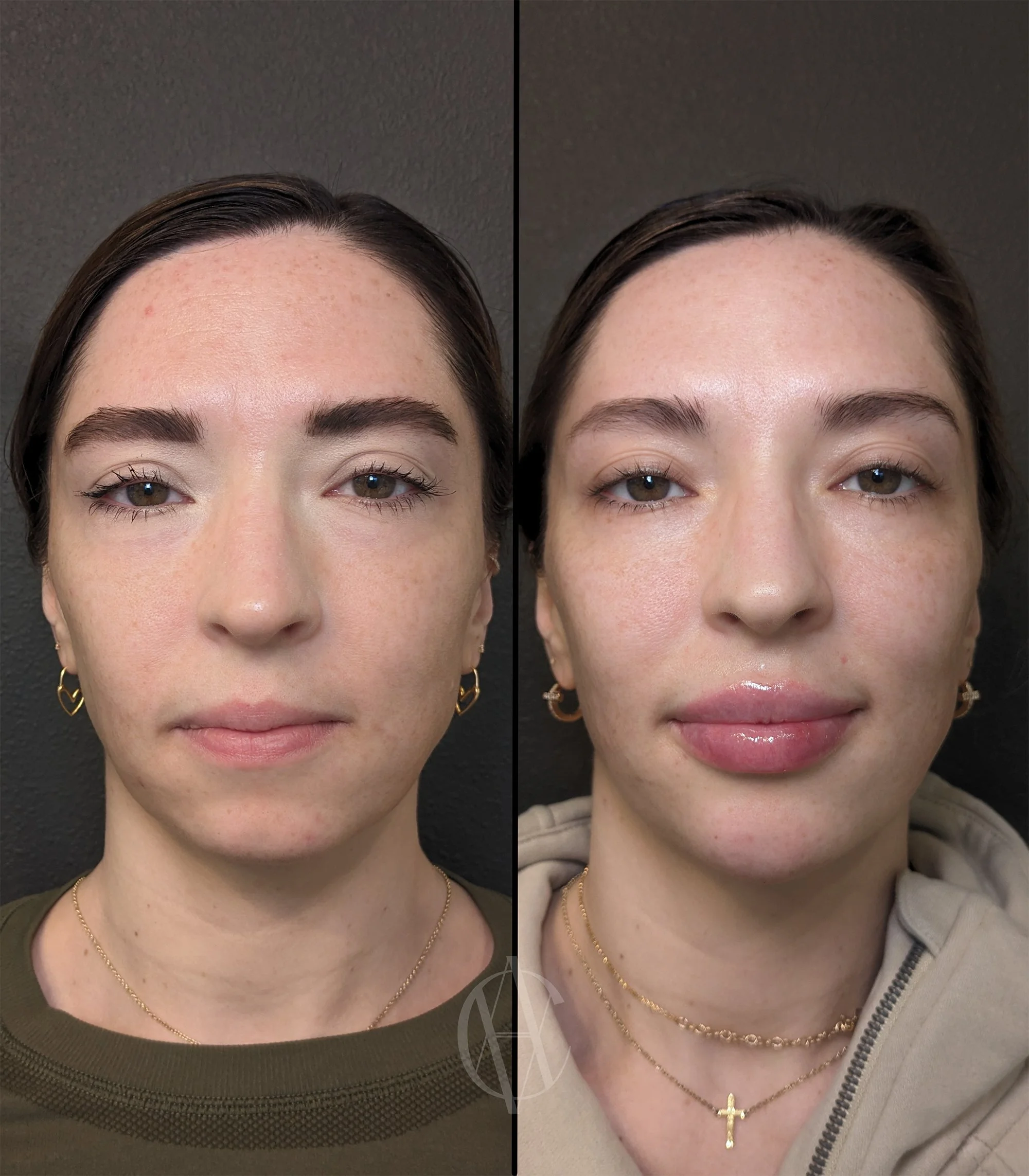 facial balancing lip cheek chin filler before and after front view New Berlin WI