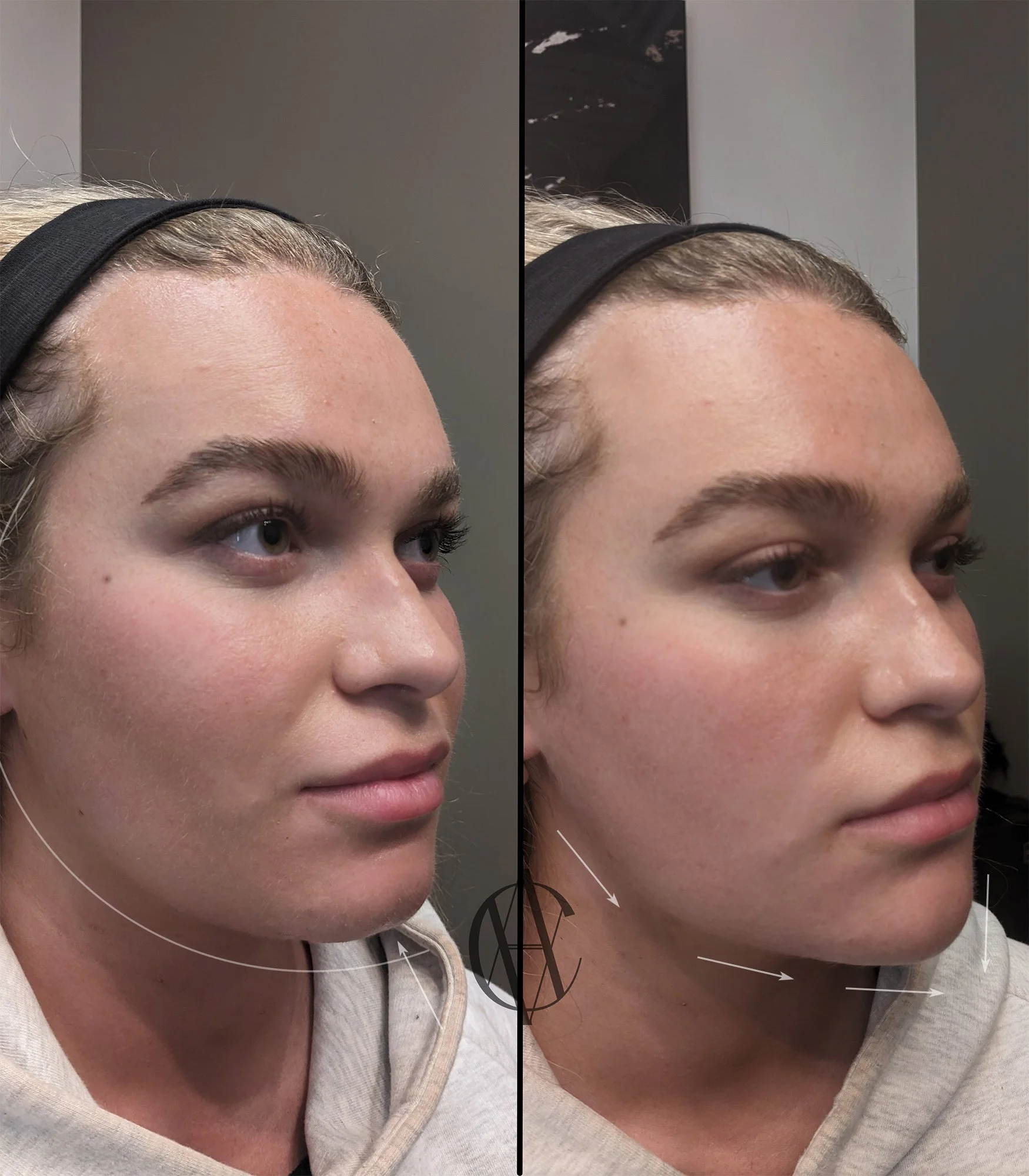 jawline and chin filler before and after annotated oblique view New Berlin WI