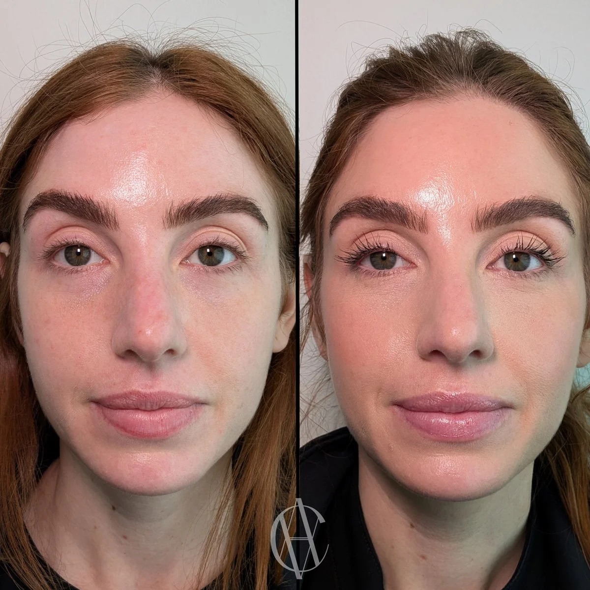 botox uneven eyebrow symmetry correction before and after front view New Berlin WI