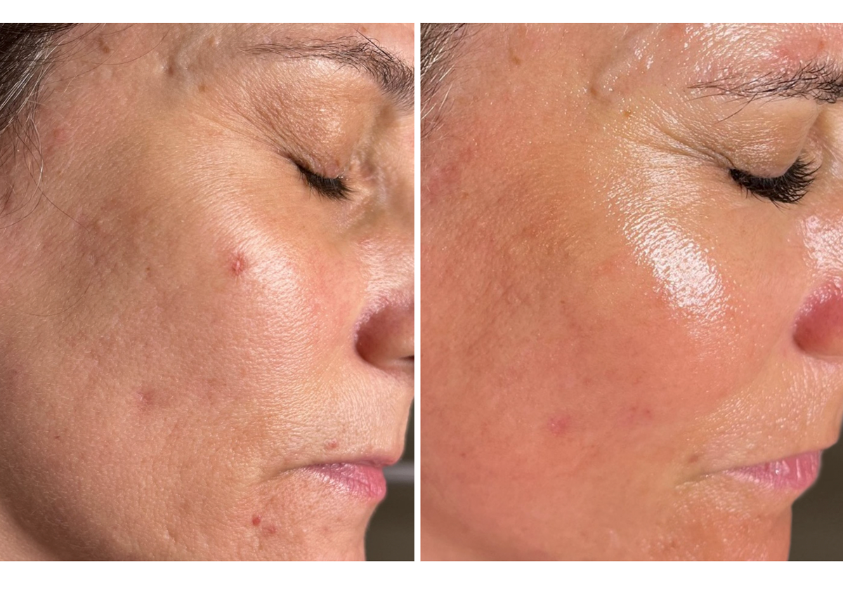 Microneedling before and after showing dramatically smoother skin texture and acne clearance on cheek at A-Class Aesthetics New Berlin WI