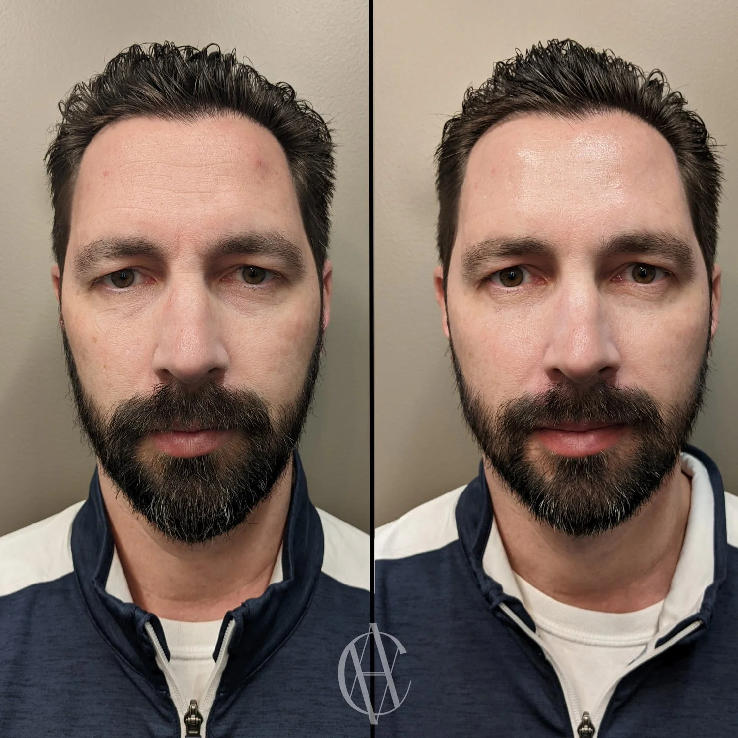 botox for men before and after forehead brow lift crows feet front view New Berlin WI