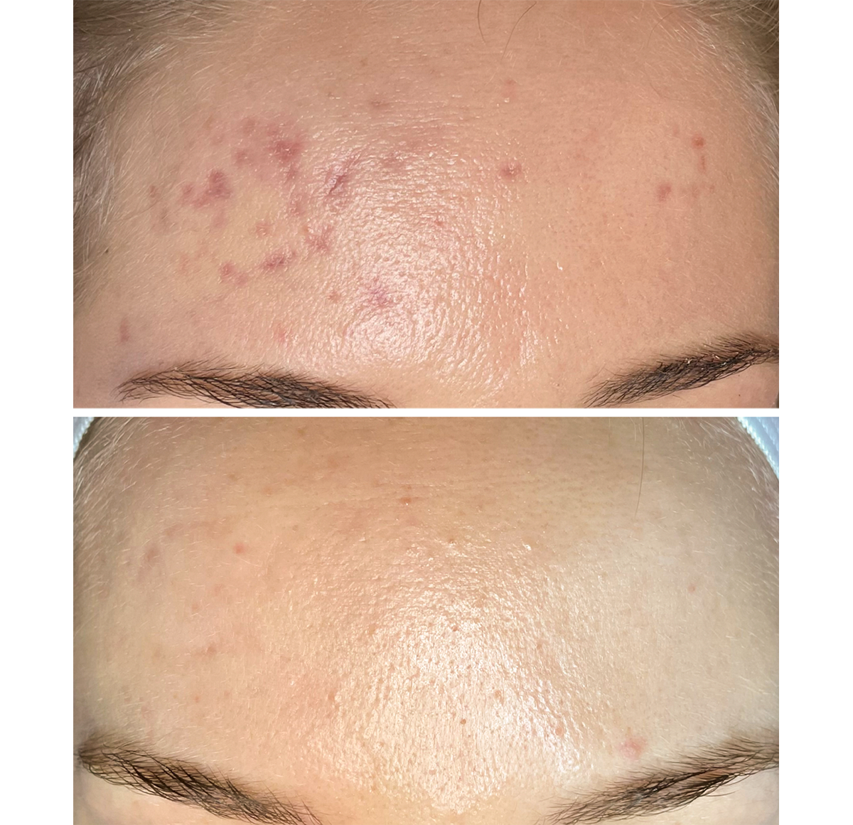 Microneedling before and after forehead acne showing dramatic clearance and smoother skin at A-Class Aesthetics in New Berlin WI