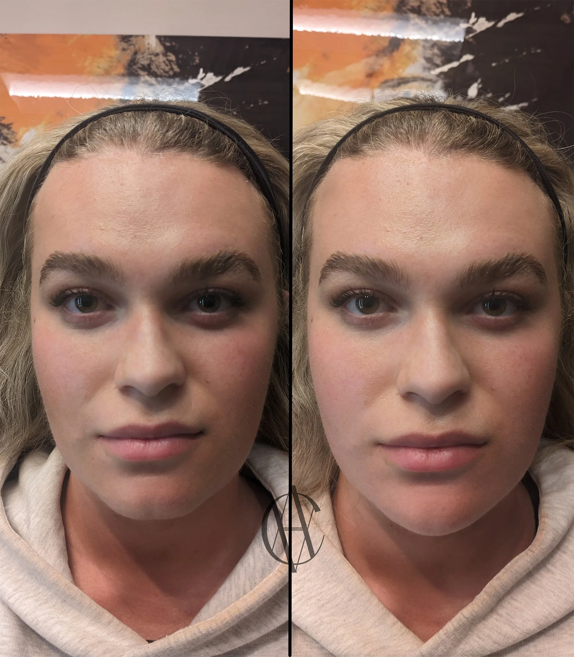 jawline and chin filler before and after annotated front view face shape New Berlin WI