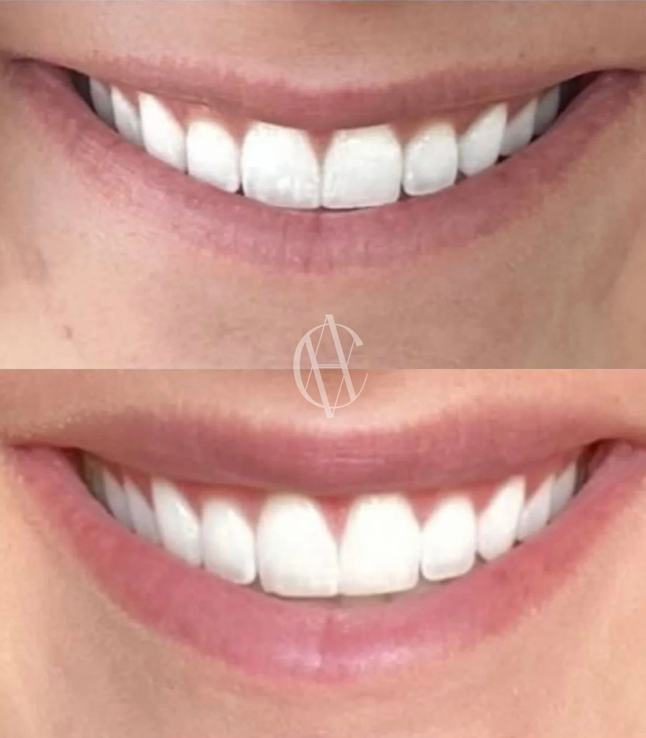 lip flip before and after smile upper lip definition New Berlin WI