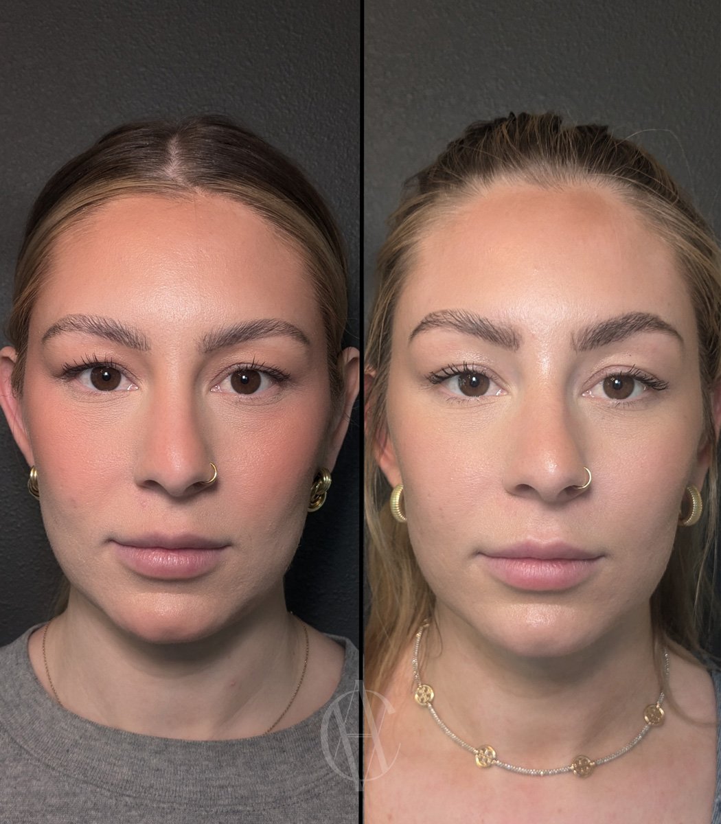 botox brow lift younger patient subtle natural before and after New Berlin WI