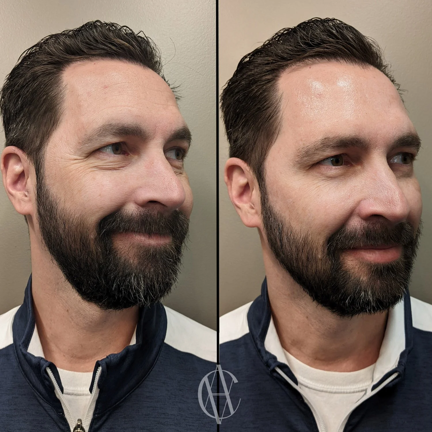 botox crows feet before and after men active smile expression New Berlin WI