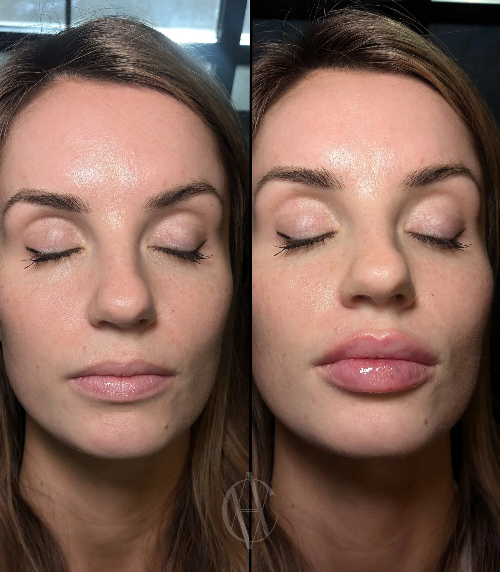 lip filler before and after volume and definition A-Class Aesthetics New Berlin WI