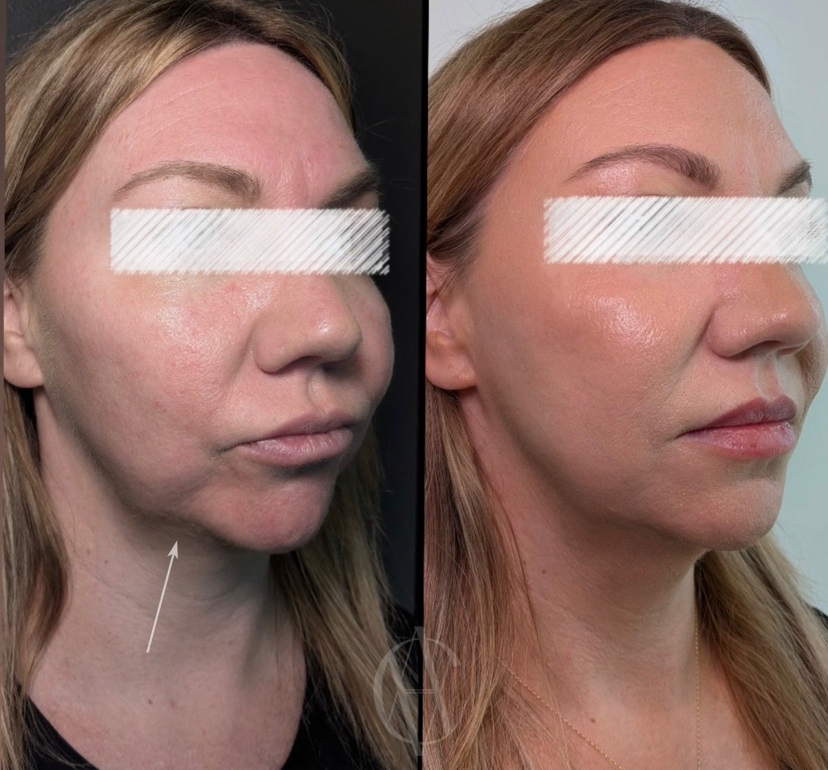 facial balancing with sculptra collagen stimulation and subtle lip filler before and after oblique view in new berlin wi