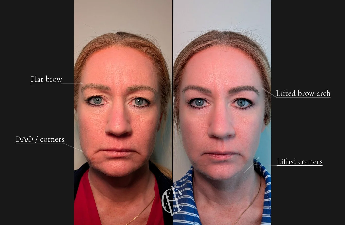 full face Dysport before and after brow lift jawline slimming lower face New Berlin WI