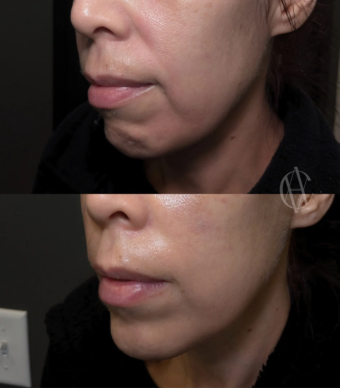 mentalis botox chin tension before and after close up lower face New Berlin WI
