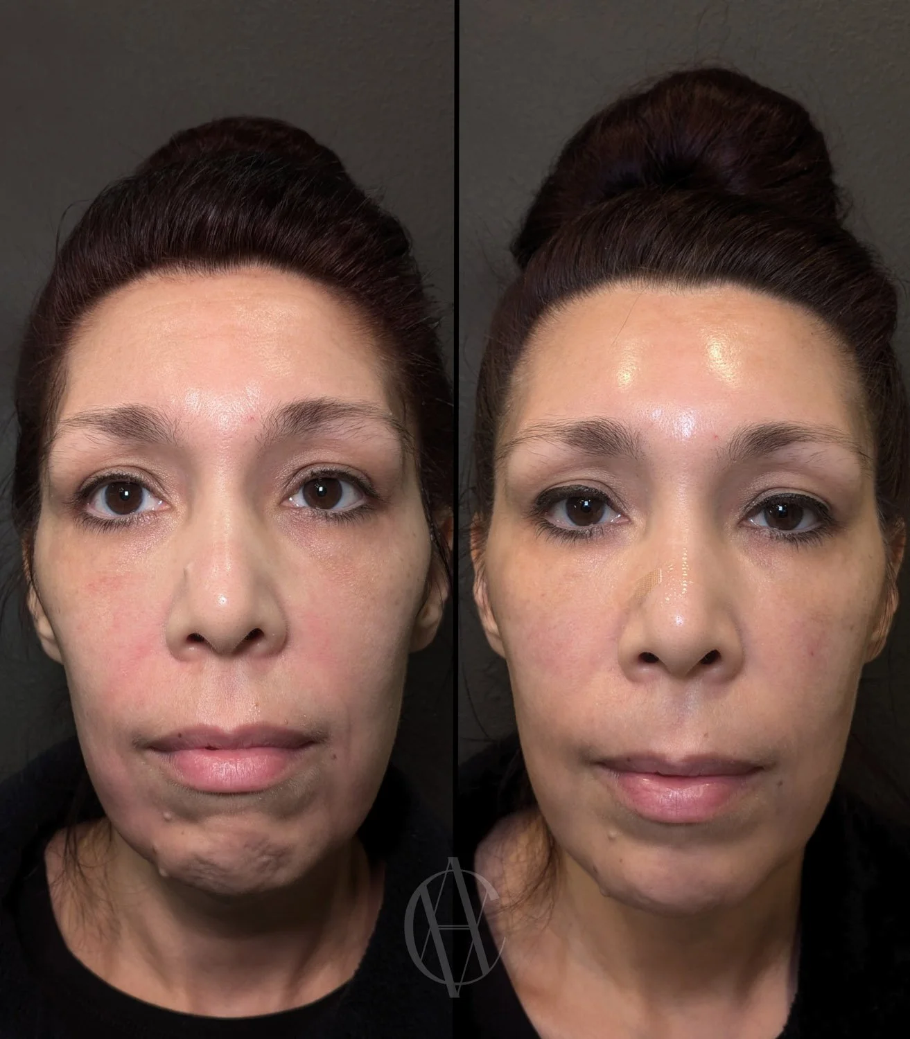 full face neurotoxin before and after lower face chin relaxation front view New Berlin WI