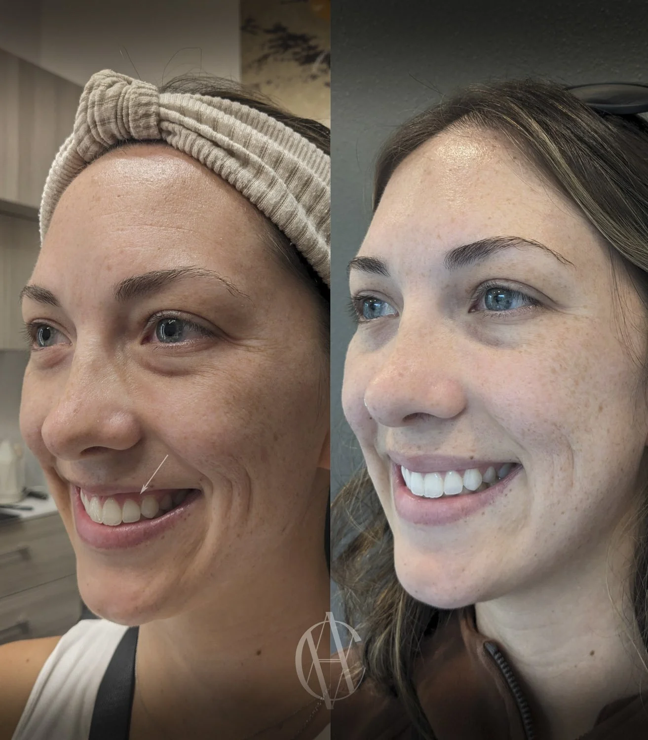 gummy smile botox before and after oblique angle showing reduced gum exposure New Berlin WI