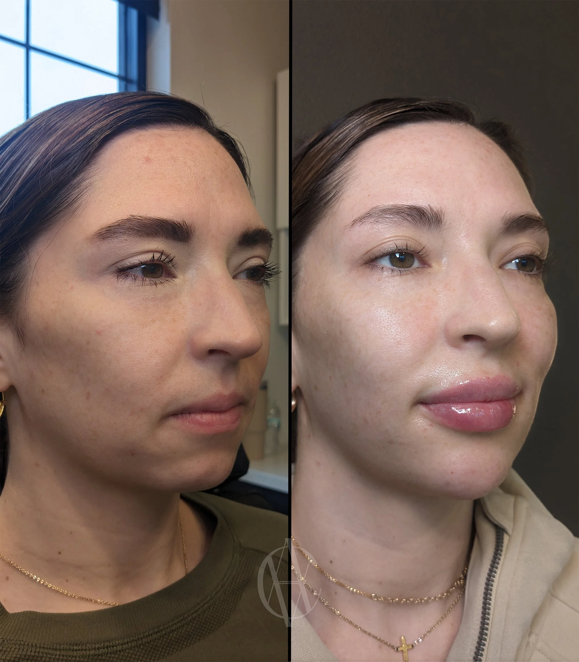 facial balancing lip cheek chin filler before and after oblique view New Berlin WI