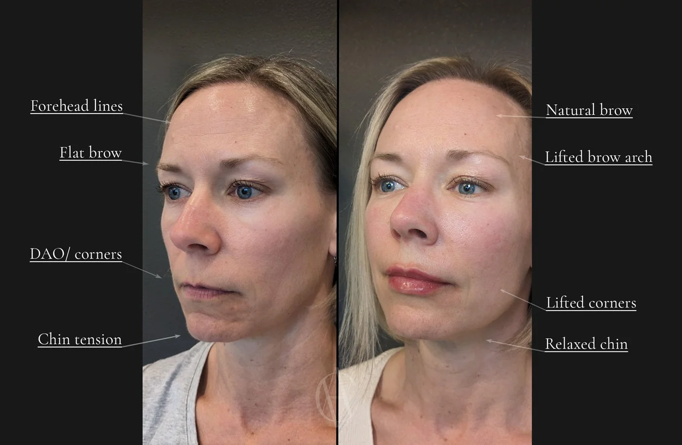 Full face Dysport before and after annotated — forehead lines, brow lift, DAO corners, chin tension, lower face New Berlin WI