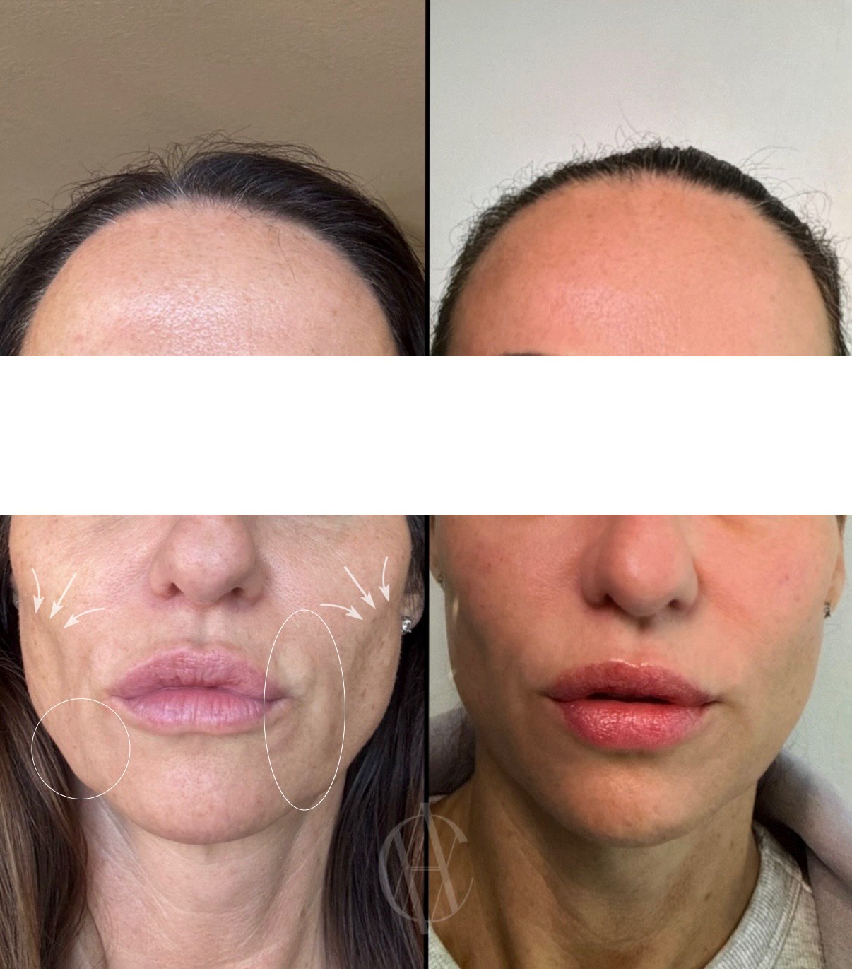 annotated sculptra before and after marking nasolabial folds marionette lines and skin texture on the lower face in new berlin wi