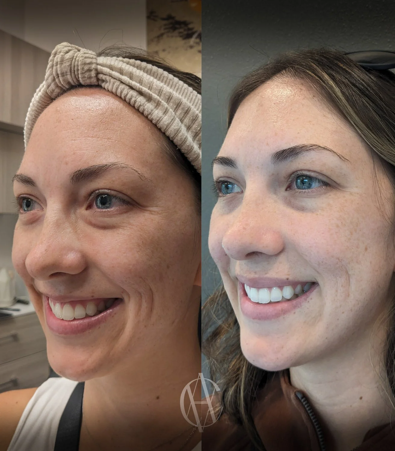 lip flip gummy smile combination before and after oblique smile view New Berlin WI