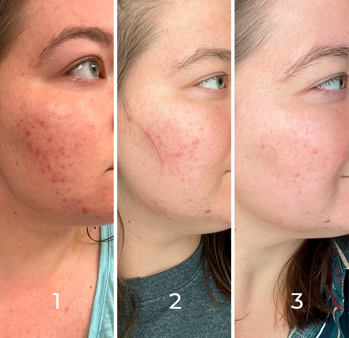 Microneedling series of 3 treatments progression showing acne clearance and smoother skin at A-Class Aesthetics in New Berlin WI