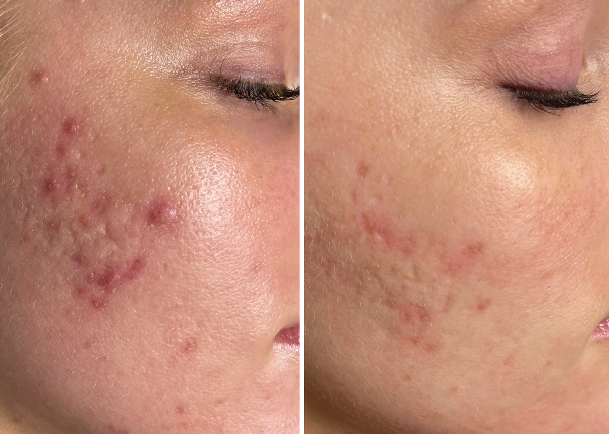 Microneedling before and after acne scars showing dramatic reduction and clearer smoother skin on cheek at A-Class Aesthetics New Berlin WI