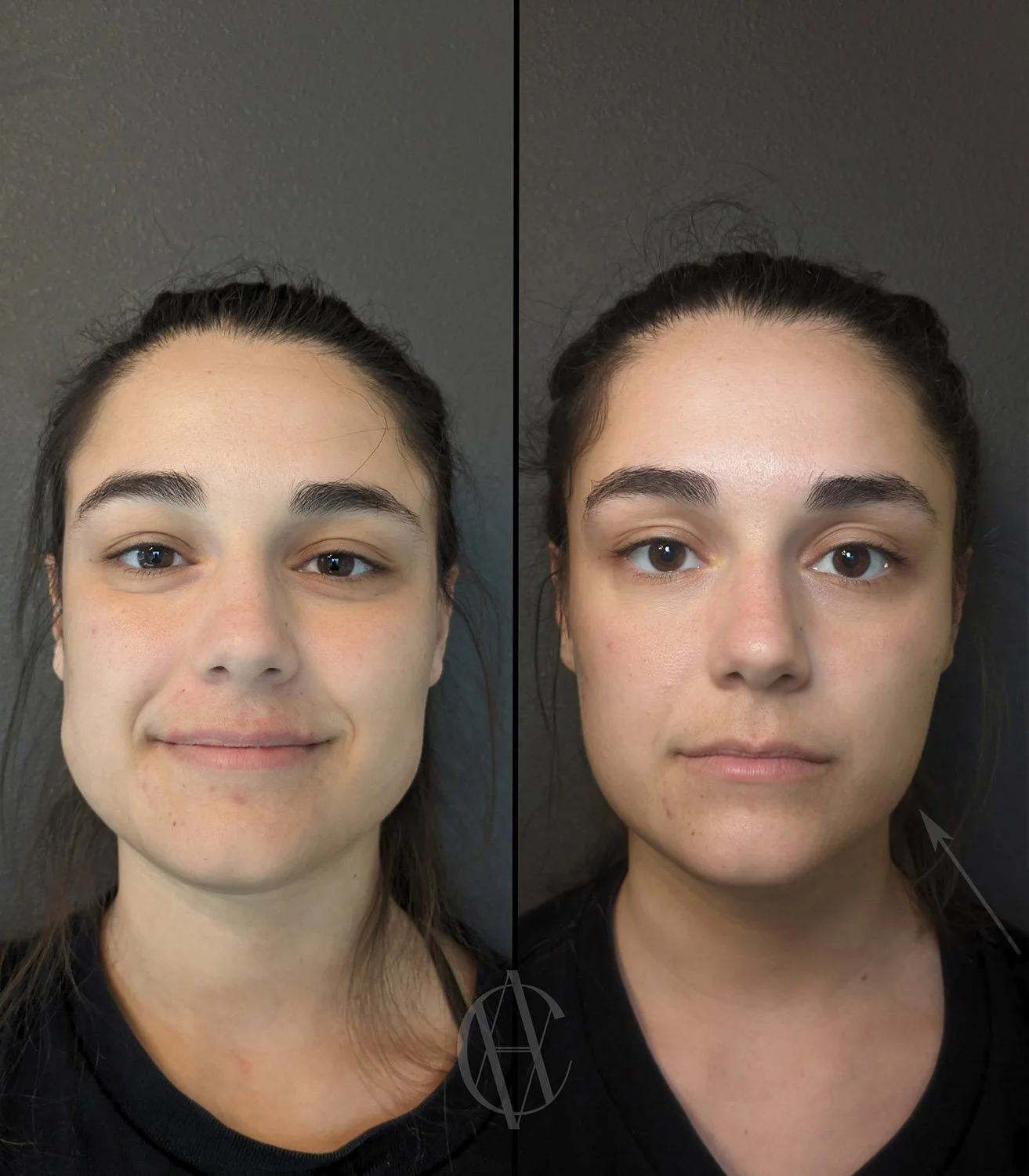 masseter botox before and after jaw slimming front view New Berlin WI