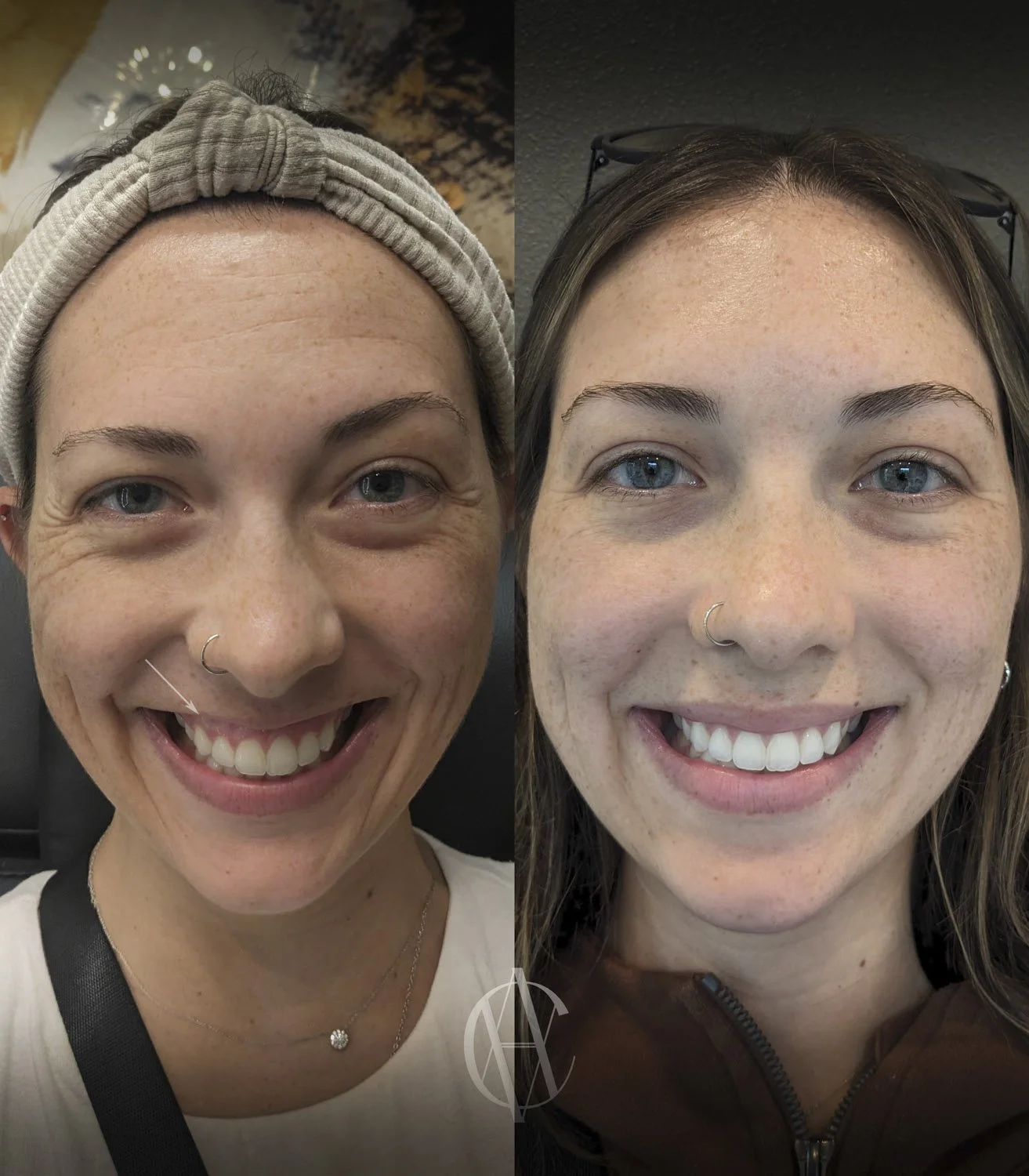 gummy smile botox before and after front view showing reduced gum exposure New Berlin WI