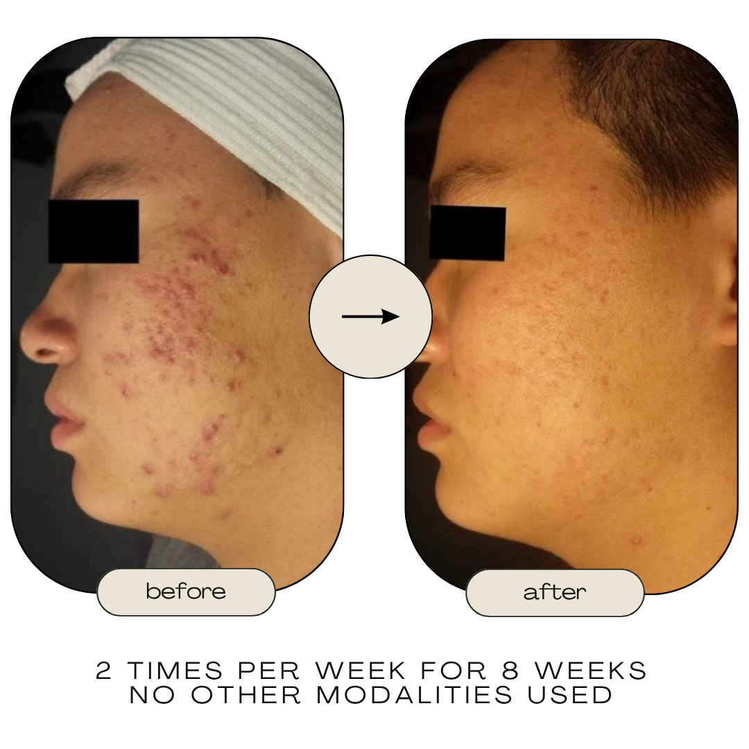 Before and after acne reduction from Celluma treatment
