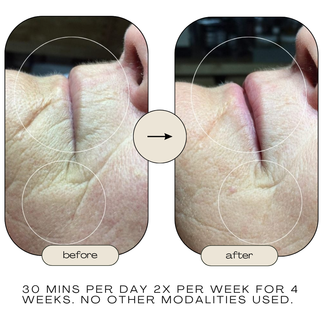 Before and after skin texture improvement from red light therapy