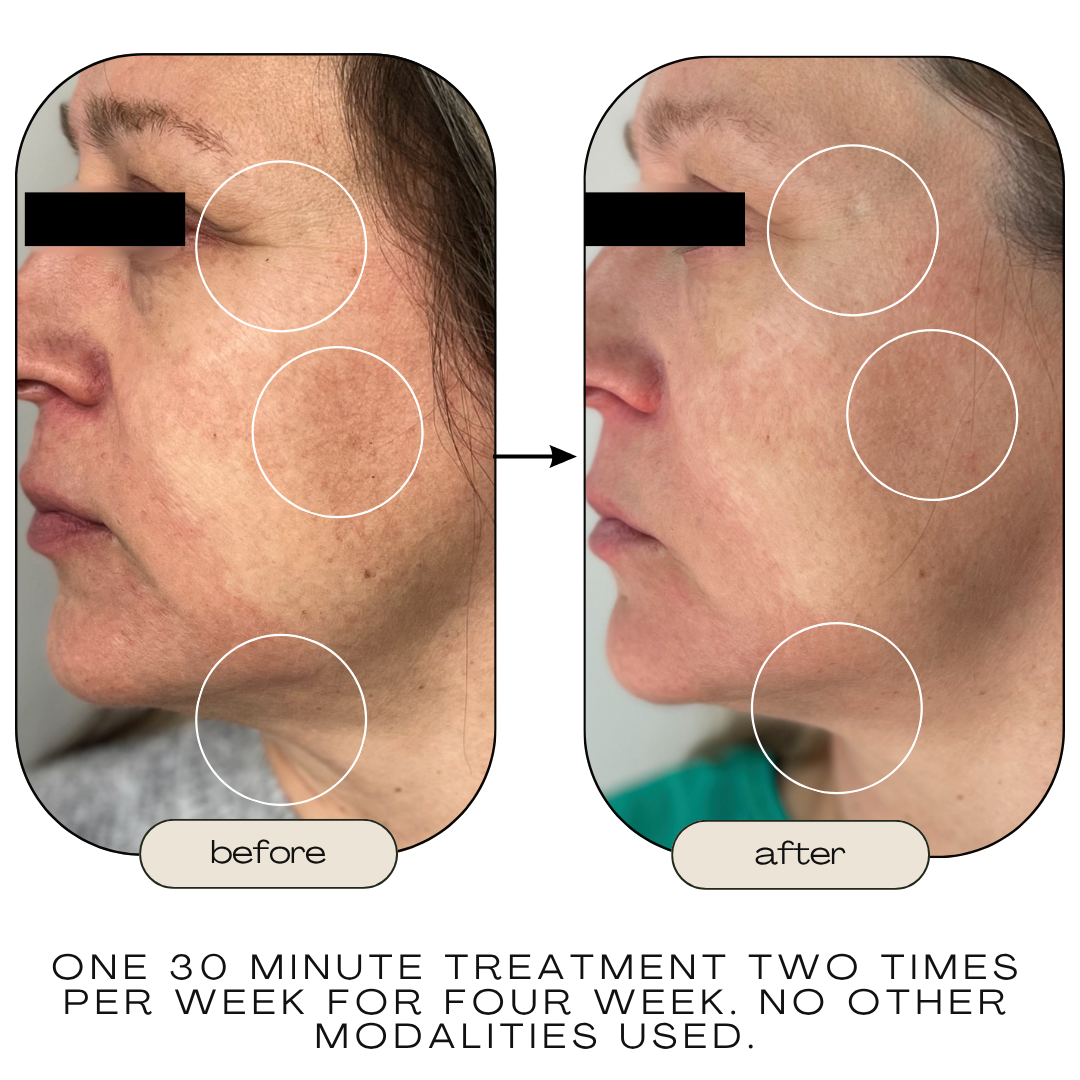 Before and after skin results from Celluma LED treatment