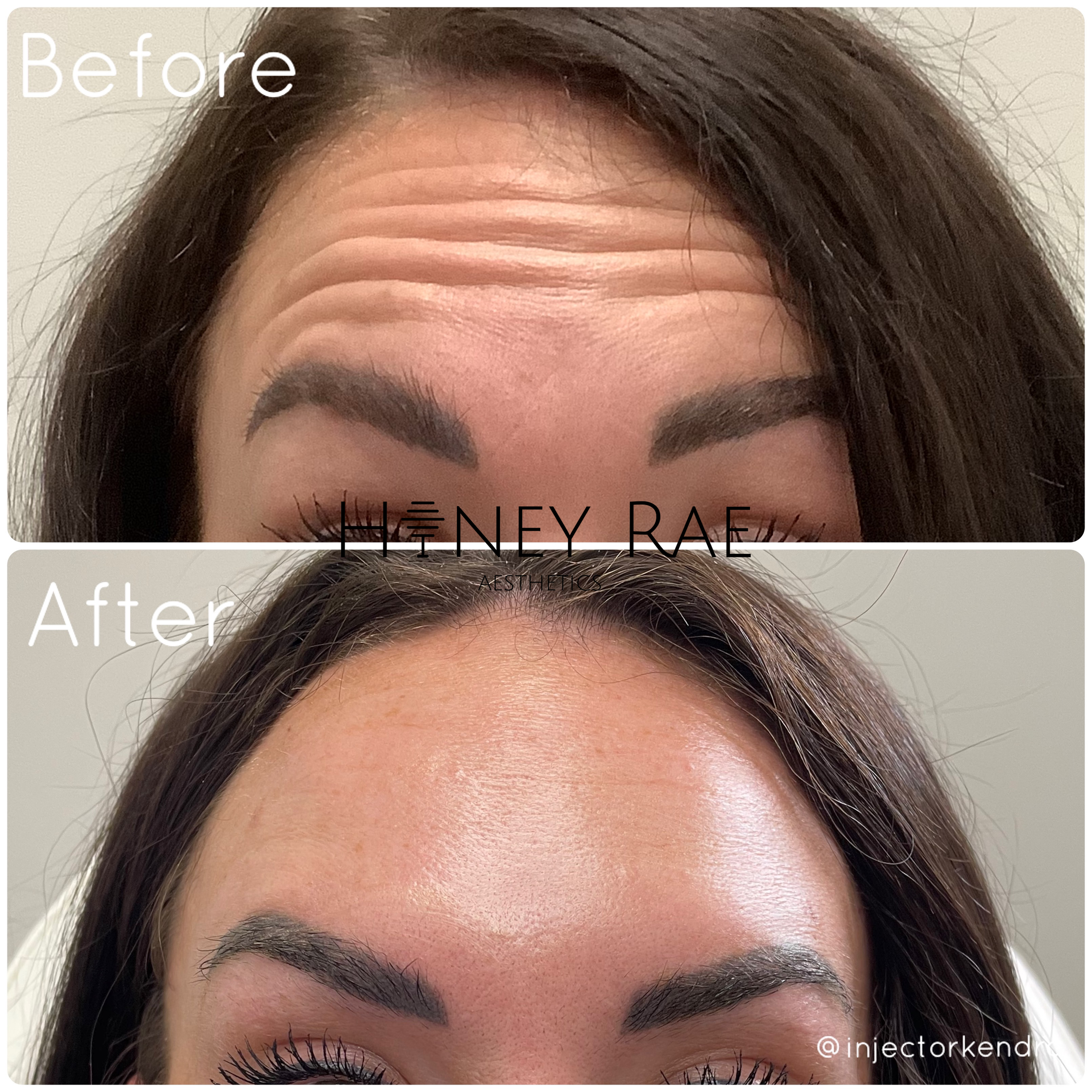 Honey Rae Botox