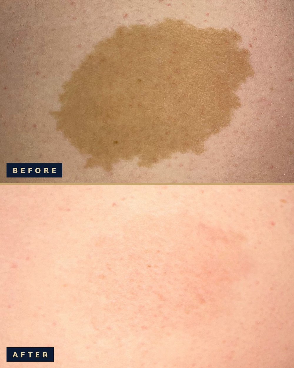 Before and after laser birthmark reduction on a pigmented birthmark: before on top showing a large brown patch, after below showing the patch almost completely faded