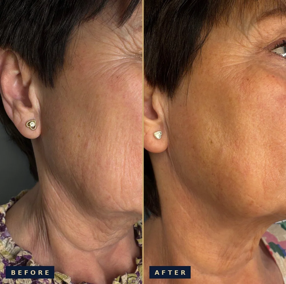 Before and after RF Microneedling on the jawline and neck: before on the left showing crepey, lined skin, after on the right showing firmer, smoother skin