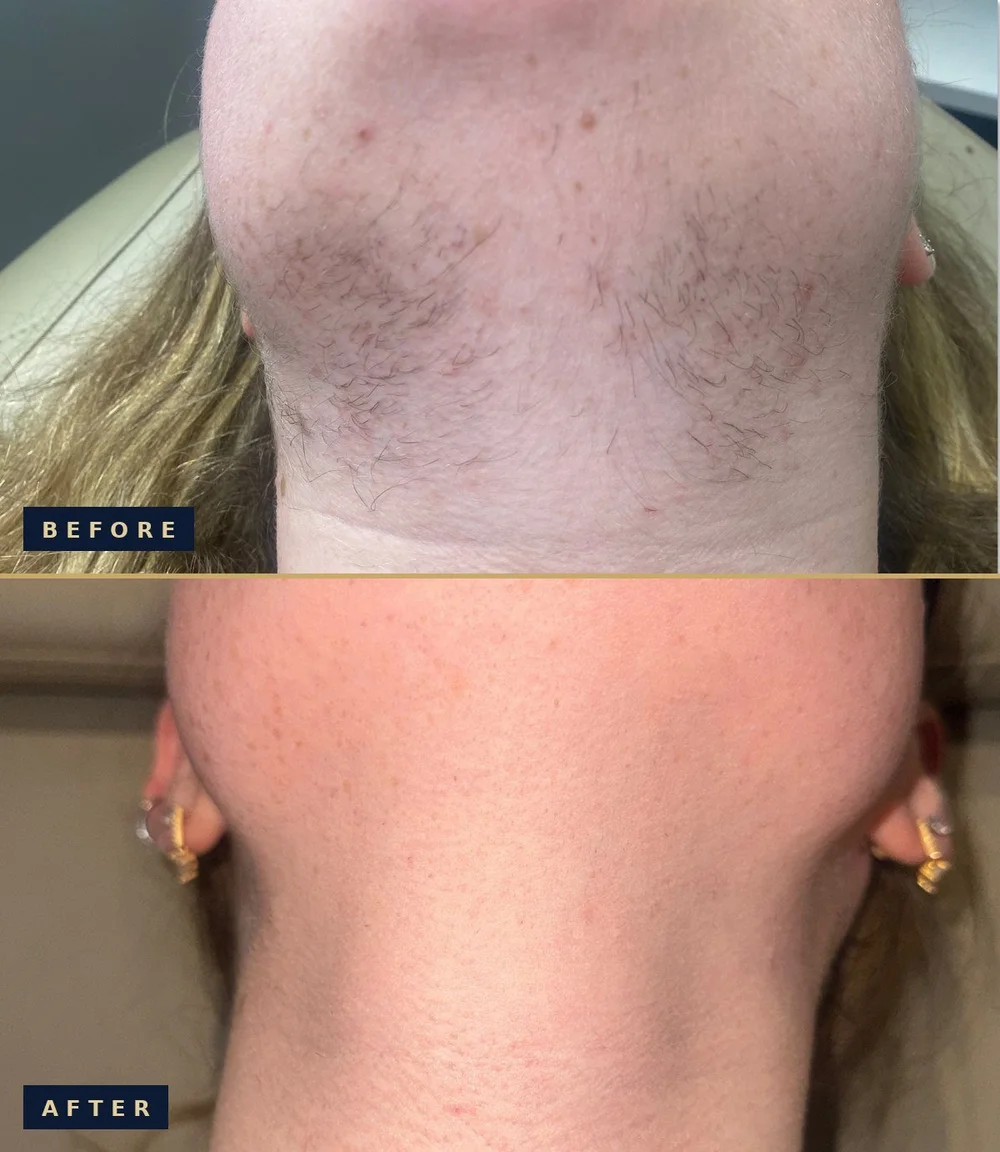 Before and after PCOS laser hair reduction on the chin and neck: before on top showing coarse dark hair, after below showing smooth skin