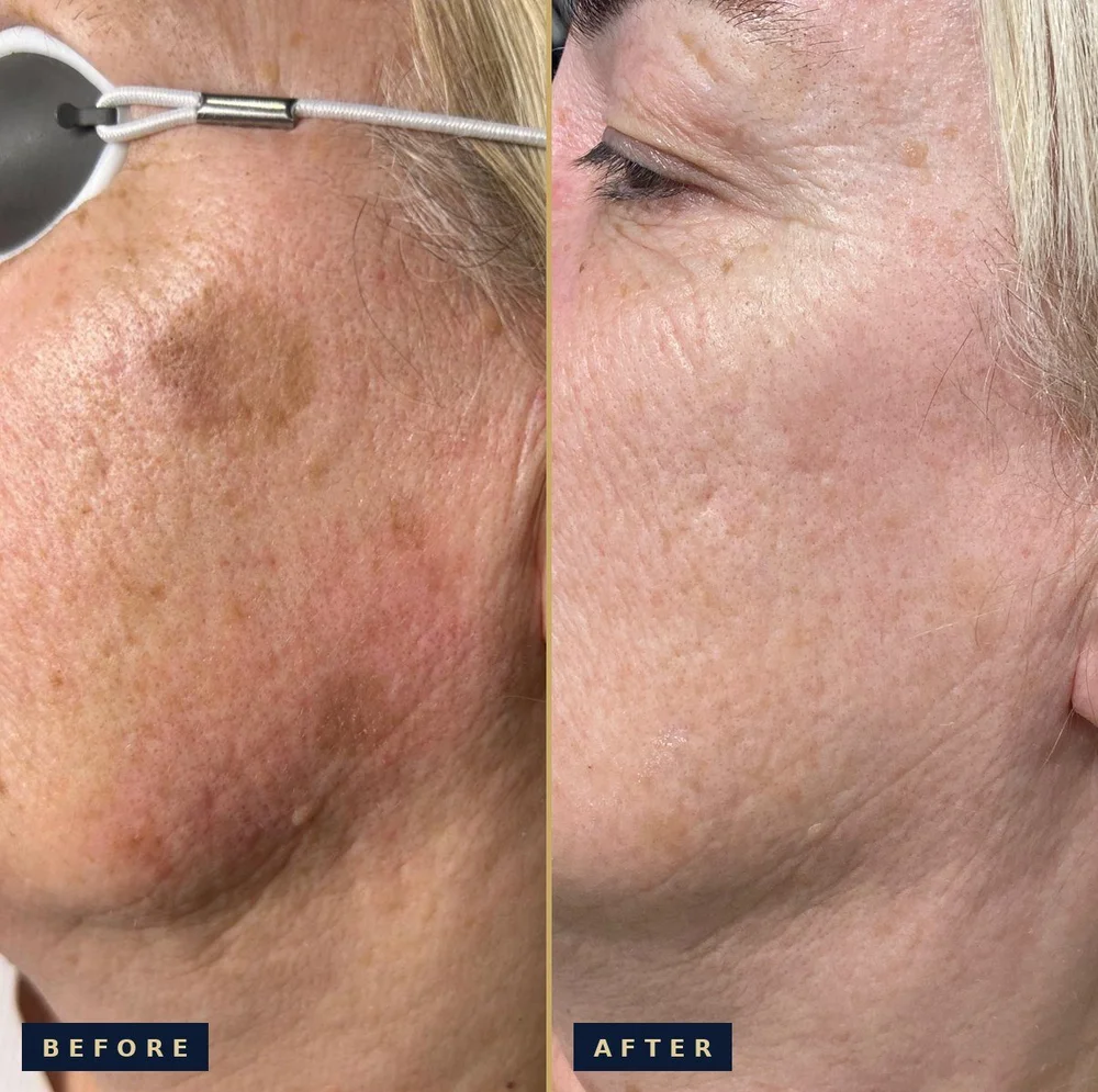 Before and after laser pigmentation treatment on the cheek: before on the left showing brown age spots, after on the right showing clearer, even skin