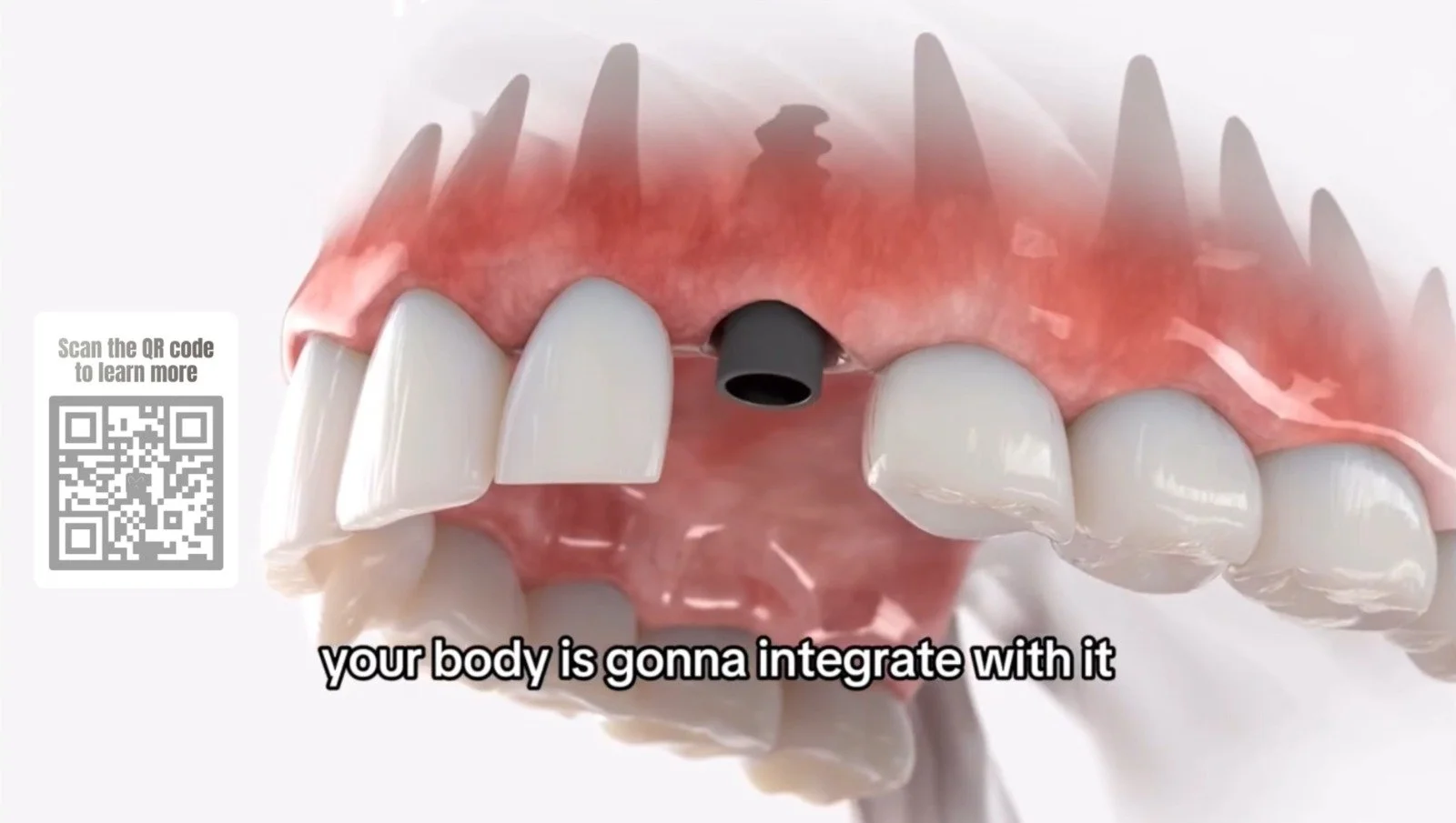 Watch: What is a dental implant — Dr. Ribeiro explains