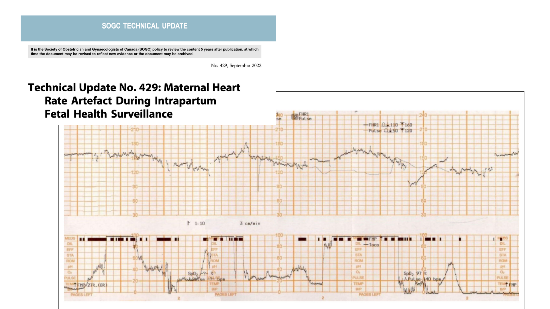 SOGC Technical Update No. 429: Maternal Heart Rate Artefact During Intrapartum Fetal Health Surveillance