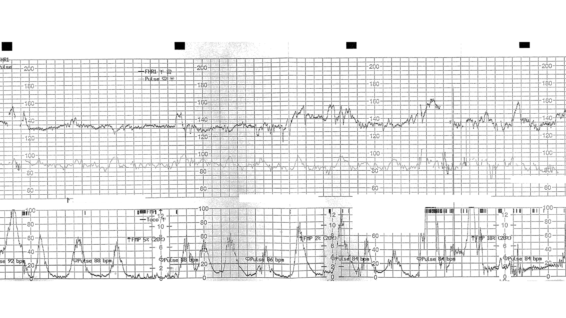 CTG trace showing maternal heart rate artefact