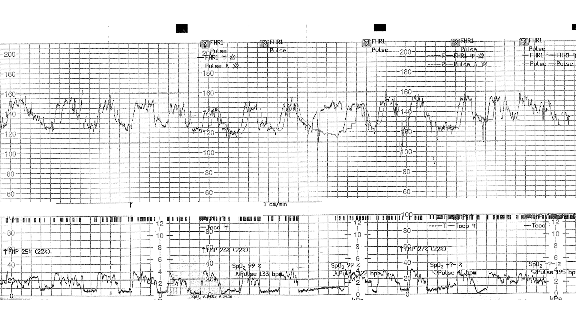 Additional CTG trace analysis