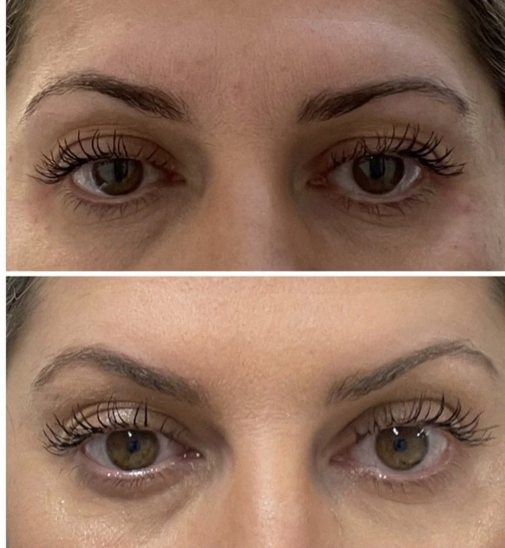 Neurotoxin before-and-after comparison 5