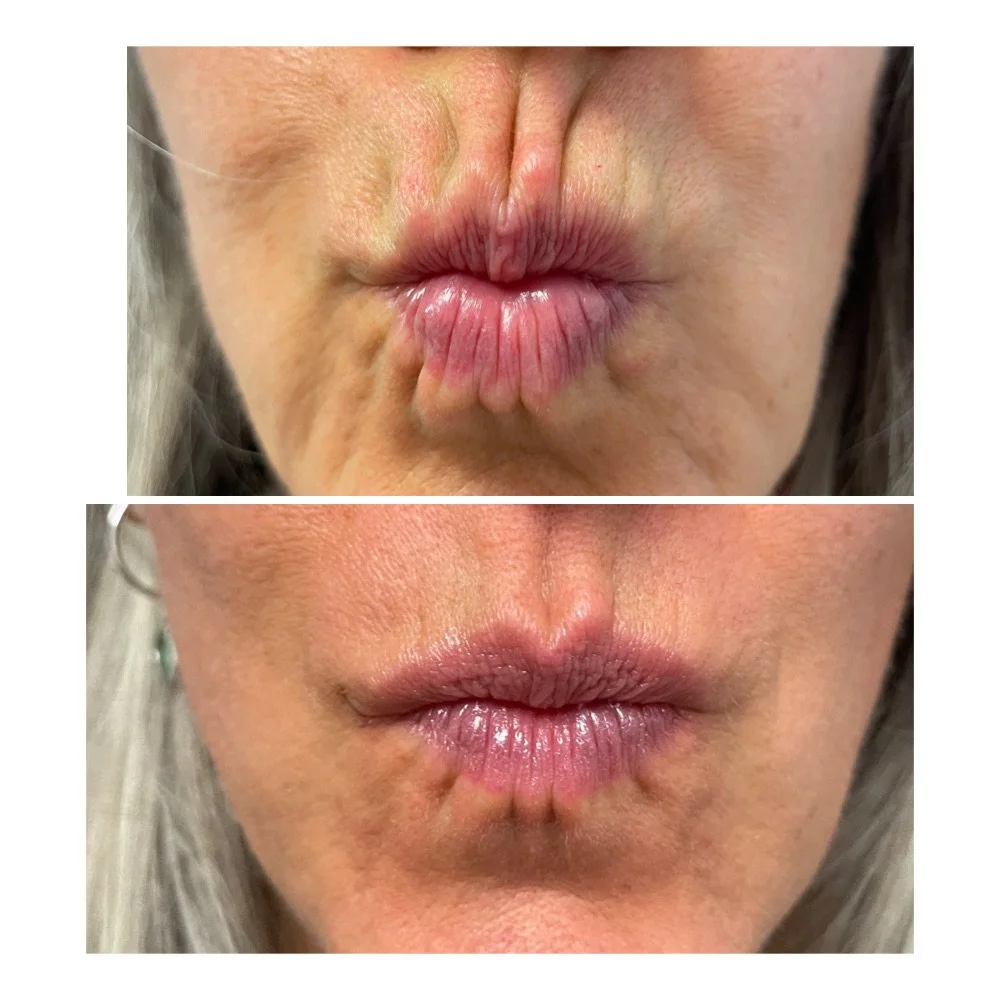 Neurotoxin before-and-after comparison 11