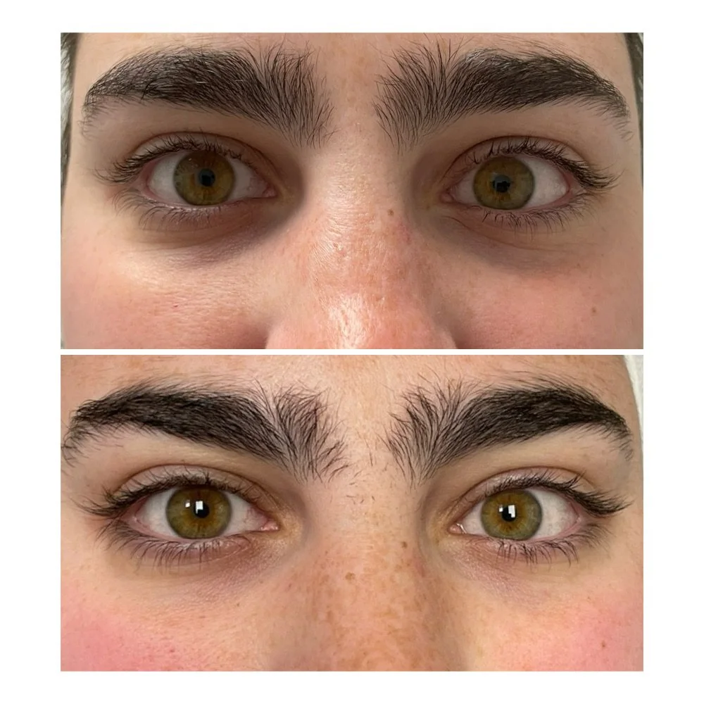 PRP Under-Eye before-and-after comparison 2