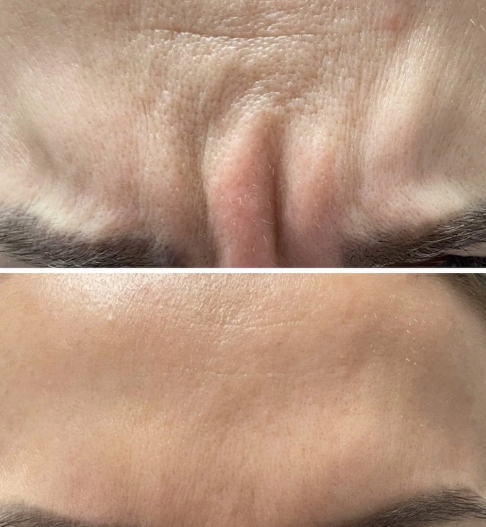 Neurotoxin before-and-after comparison 7