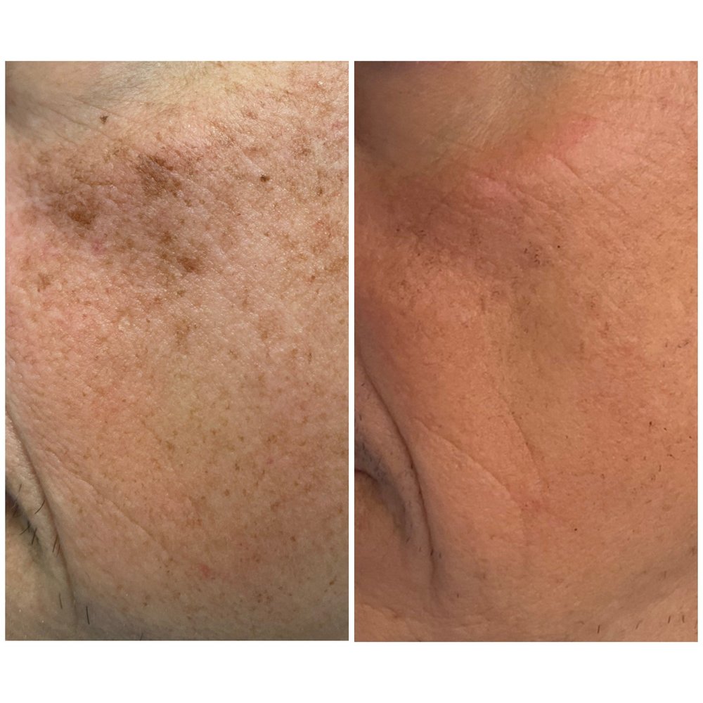 Laser Treatments before-and-after comparison 8