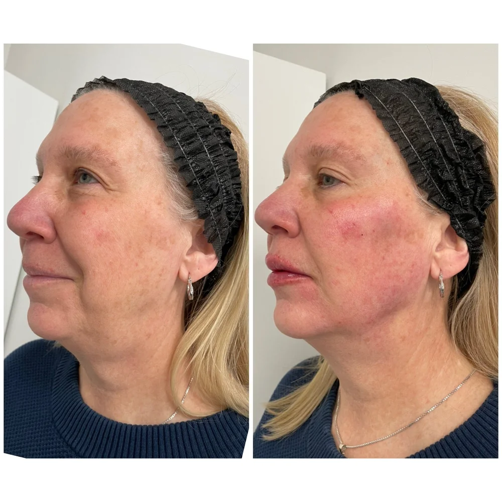 Facial Balancing before-and-after comparison 3
