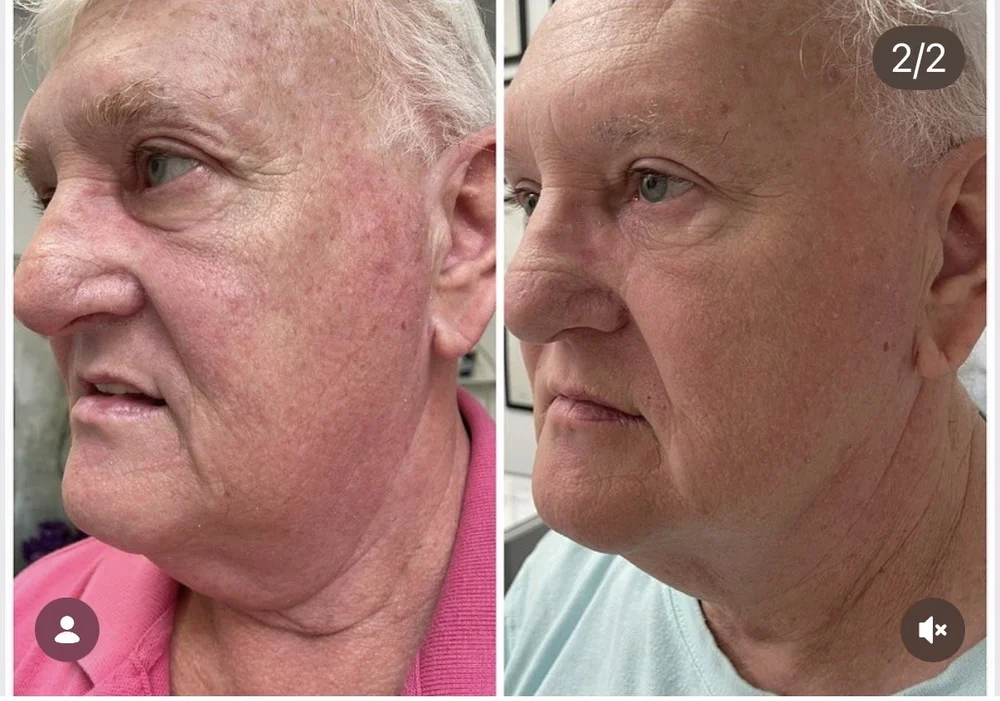 Laser Treatments before-and-after comparison 14