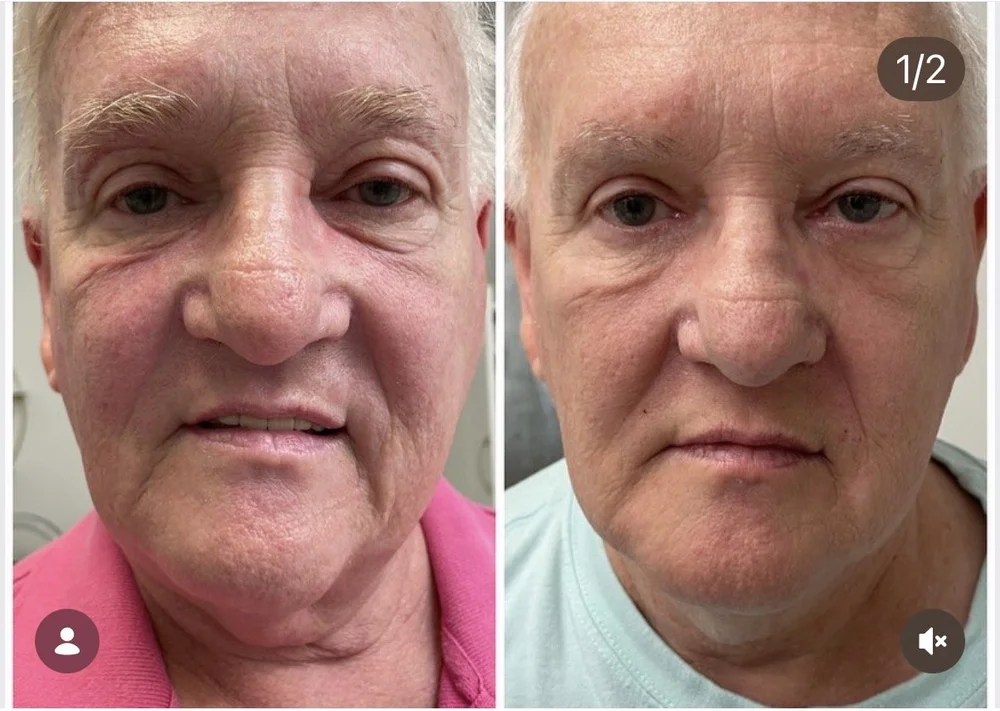 Laser Treatments before-and-after comparison 13