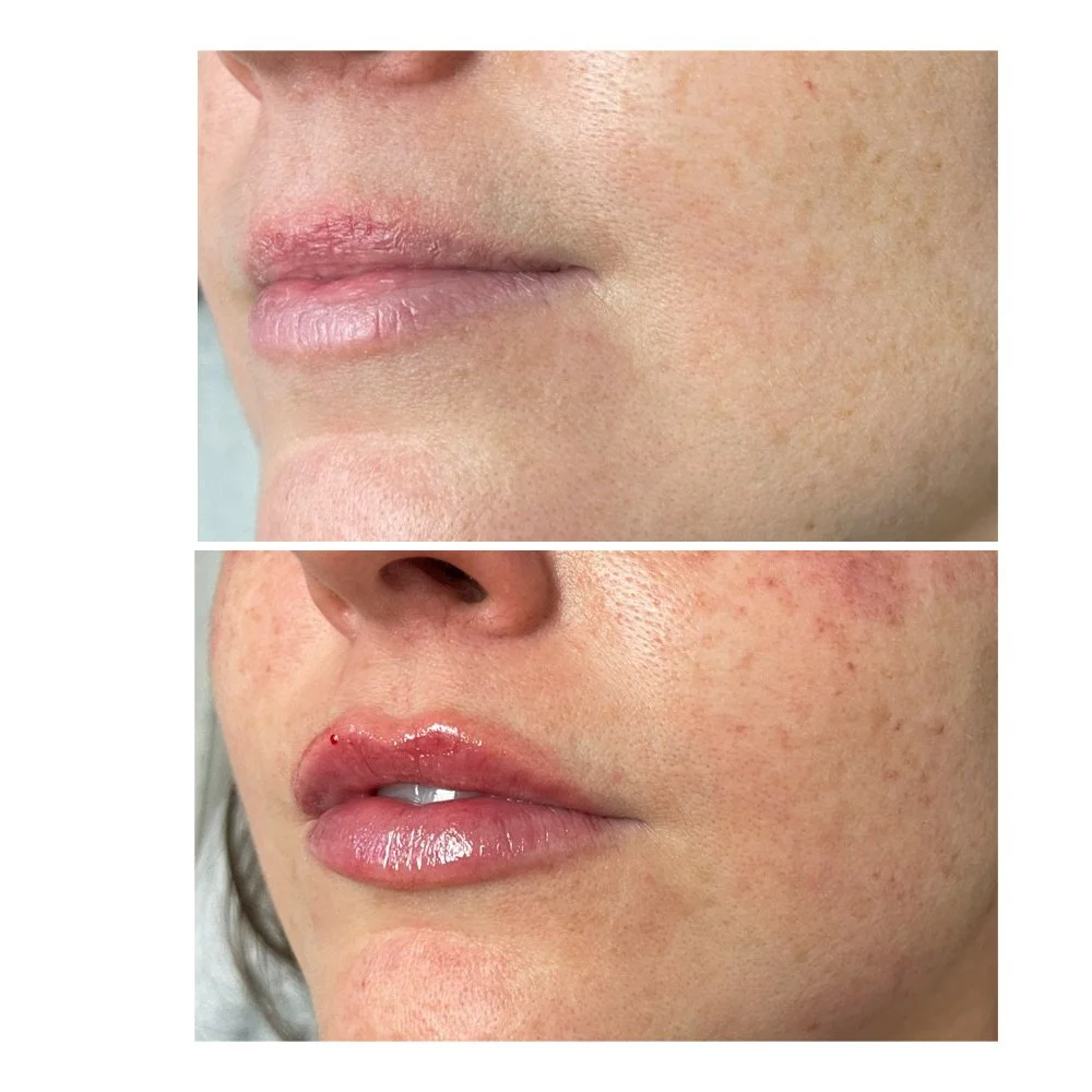 Lip Fillers before-and-after comparison 38
