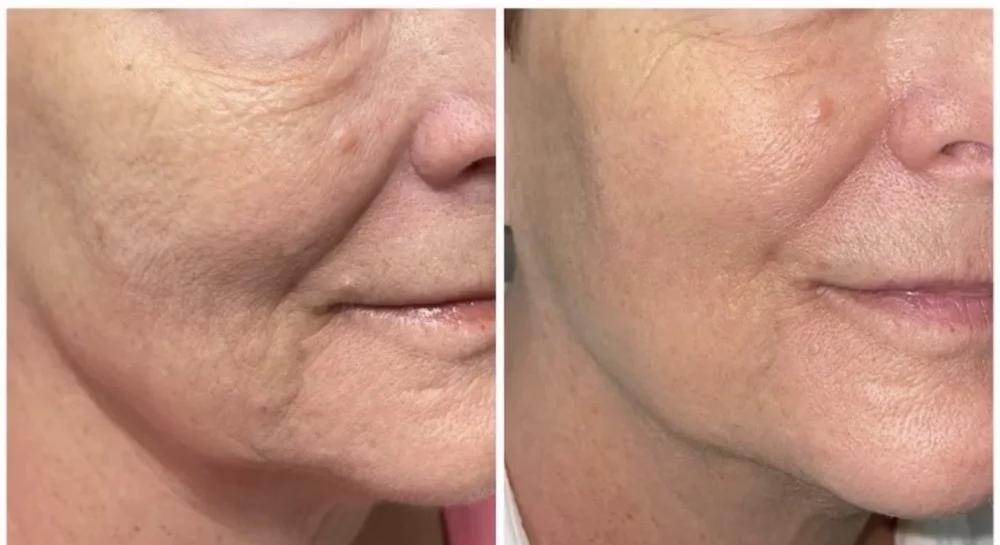 Sculptra & Radiesse before-and-after comparison 2