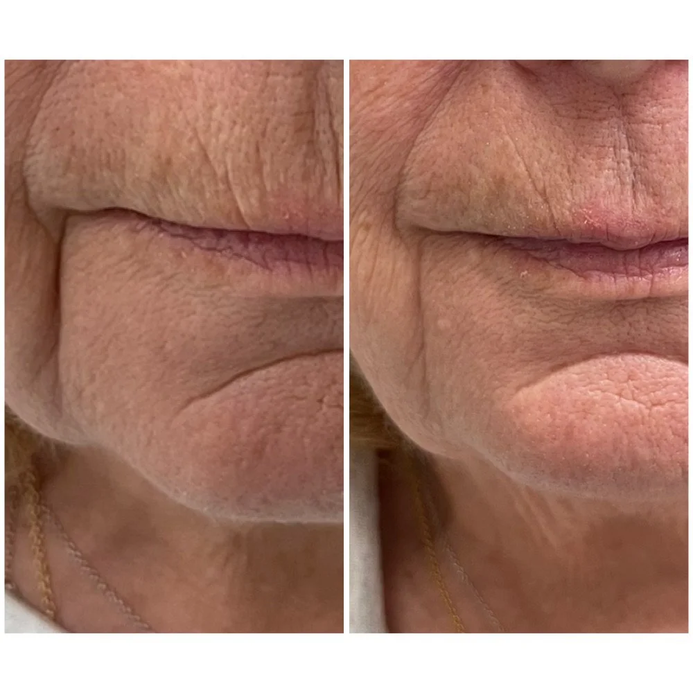 Facial Balancing before-and-after comparison 10