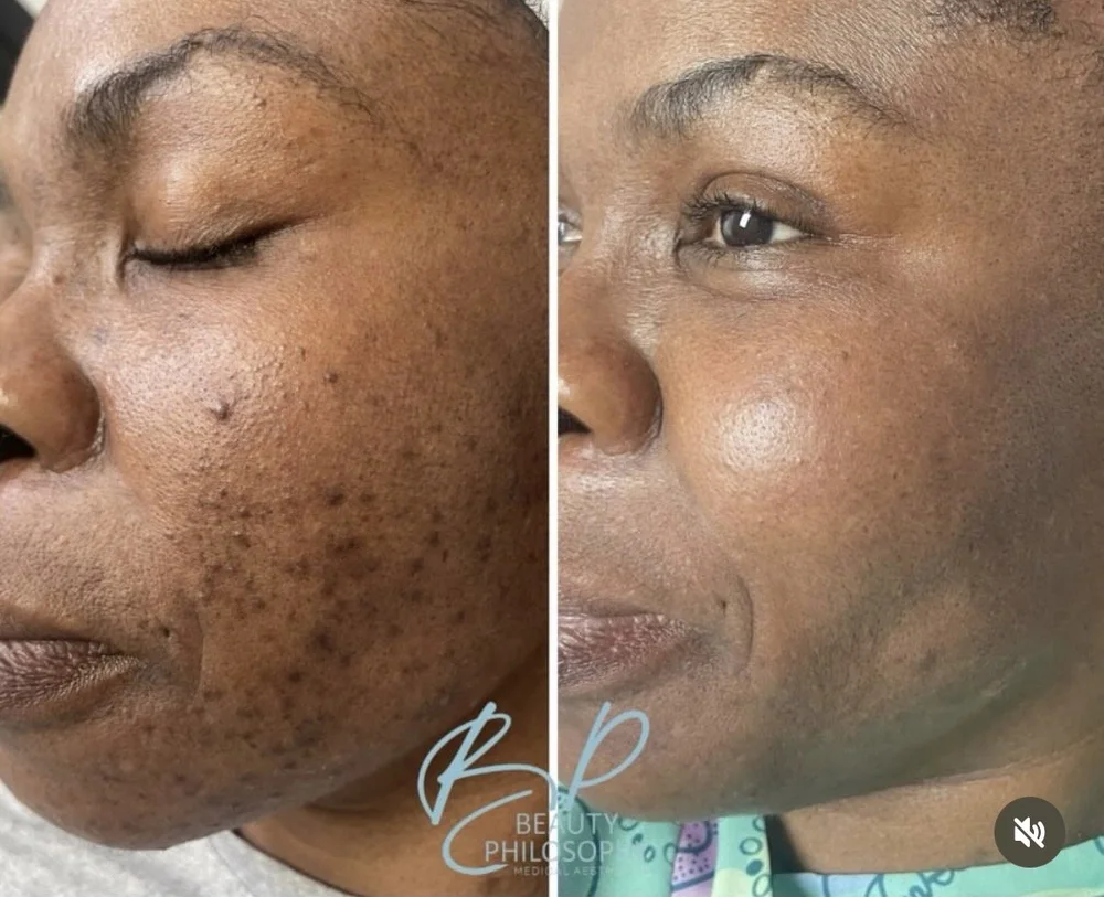 PRX, Peels & Acne before-and-after comparison 4