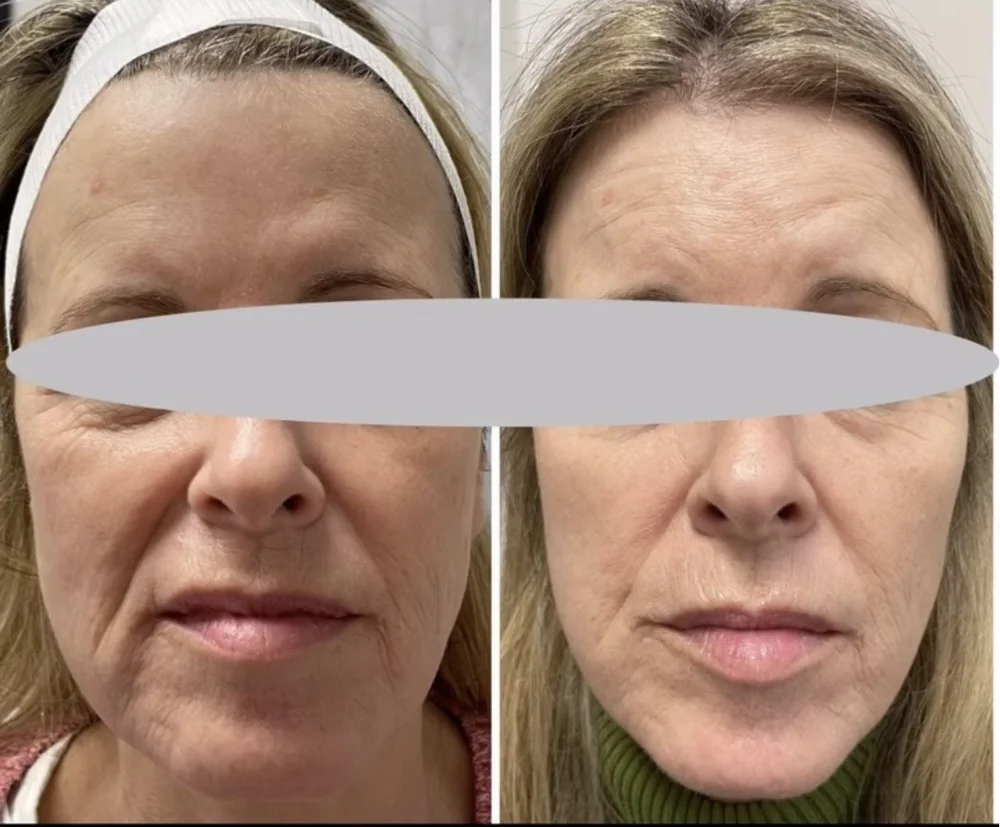 Sculptra & Radiesse before-and-after comparison 4