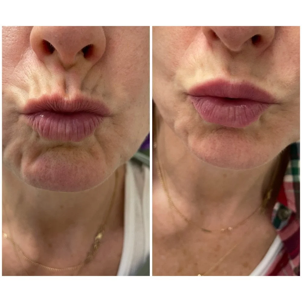 Neurotoxin before-and-after comparison 3